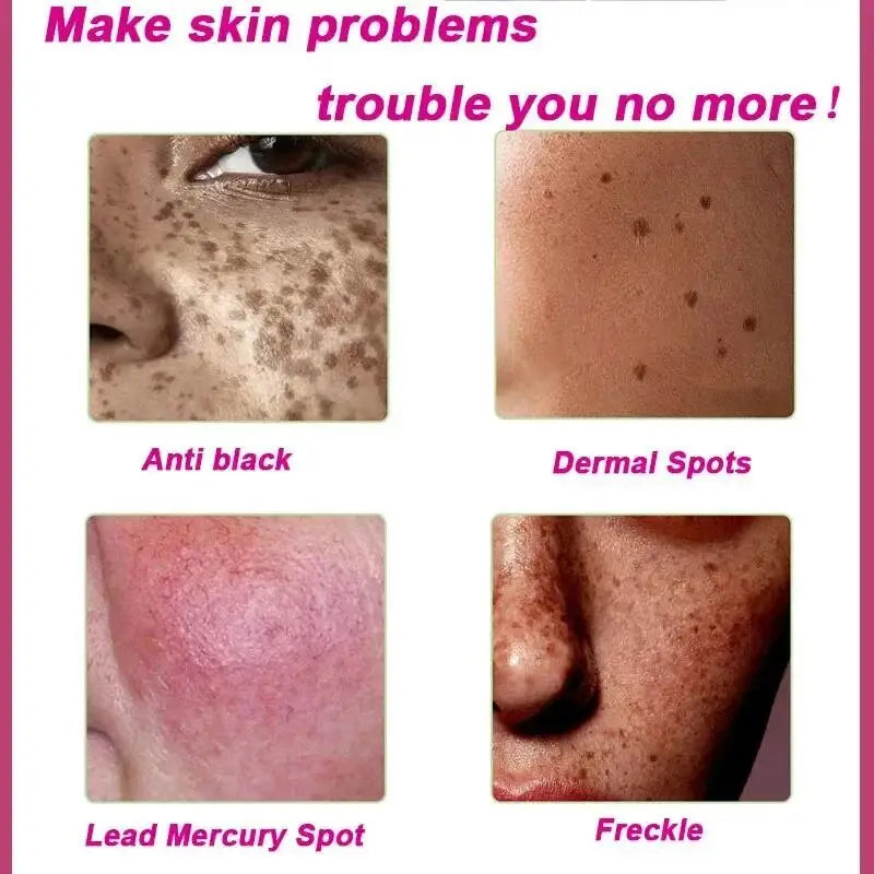 Dark Spots Remover Whitening Serum Face Freckle Melanin Correcting anti Pigmentation Brighten Beauty Korean Day Night Skin Care