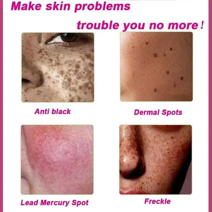 Dark Spots Remover Whitening Serum Face Freckle Melanin Correcting anti Pigmentation Brighten Beauty Korean Day Night Skin Care