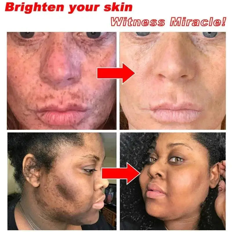 Dark Spots Remover Whitening Serum Face Freckle Melanin Correcting anti Pigmentation Brighten Beauty Korean Day Night Skin Care