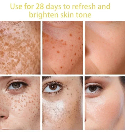 Dark Spots Remover Whitening Serum Face Freckle Melanin Correcting anti Pigmentation Brighten Beauty Korean Day Night Skin Care
