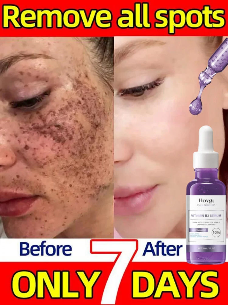 Dark Spots Remover Whitening Serum Face Freckle Melanin Correcting anti Pigmentation Brighten Beauty Korean Day Night Skin Care