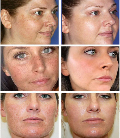 Dark Spots Remover Whitening Serum Face Freckle Melanin Correcting anti Pigmentation Brighten Beauty Korean Day Night Skin Care